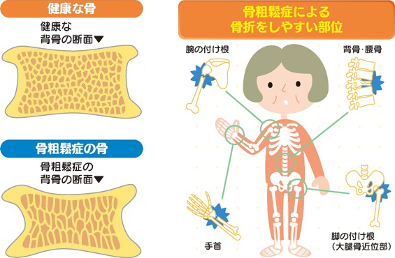 骨粗鬆症